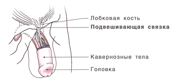 Лигаментотомия - операция по удлинению полового члена
